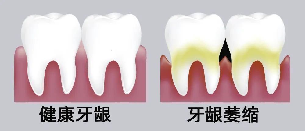 牙縫大露出“黑三角”，既塞牙又難看！還能恢復嗎？