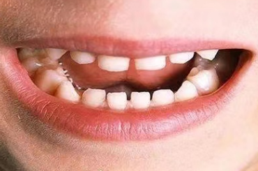 口腔健康，從娃娃抓起！6大兒牙常見(jiàn)問(wèn)題，家長(zhǎng)們要注意了！